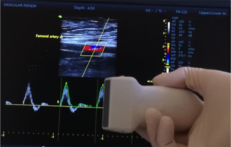 Ce este ecografia doppler vasculara?