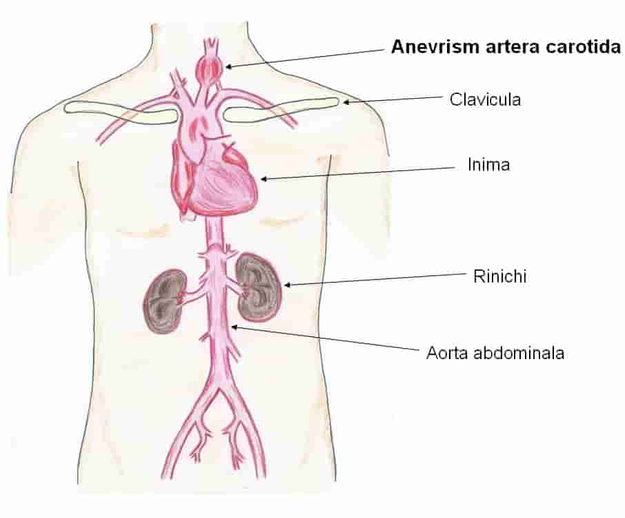 Care sunt arterele carotide si unde se afla acestea?